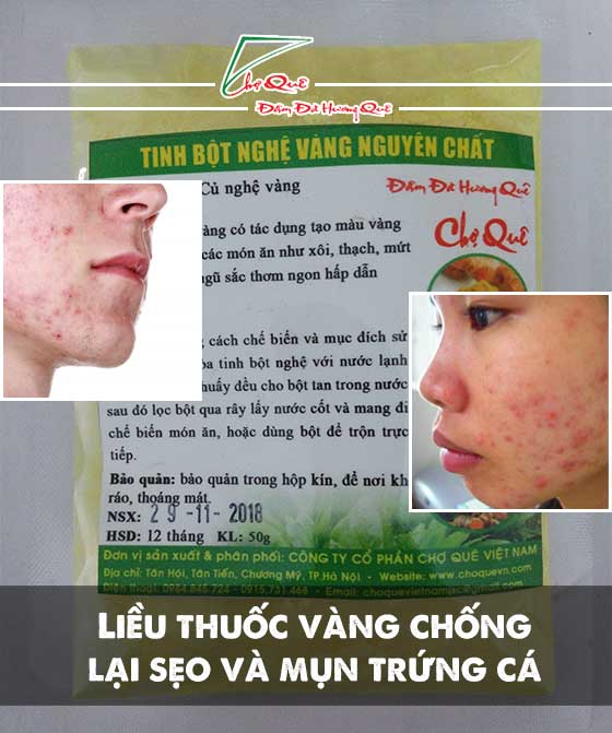 tinh bột nghệ vàng, liều thuốc vàng chống lại sẹo và mụn trứng cá